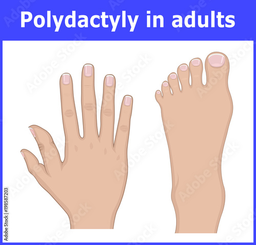 Illustration of Polydactyly in adults