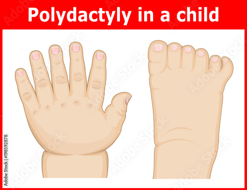 Illustration of Polydactyly in a child