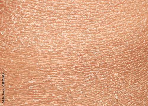  texture of the epidermis of human skin with flakes and cracked particles closeup photo