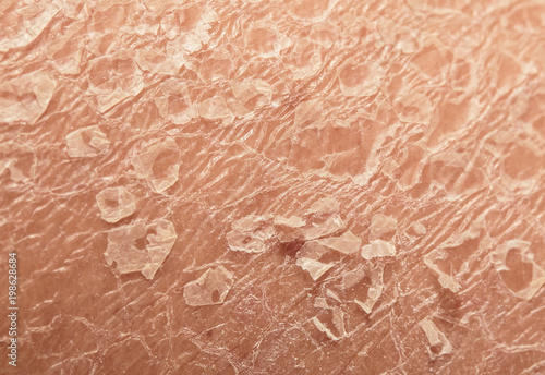  texture of the unhealthy human skin epidermis with flaky and cracked particles close up