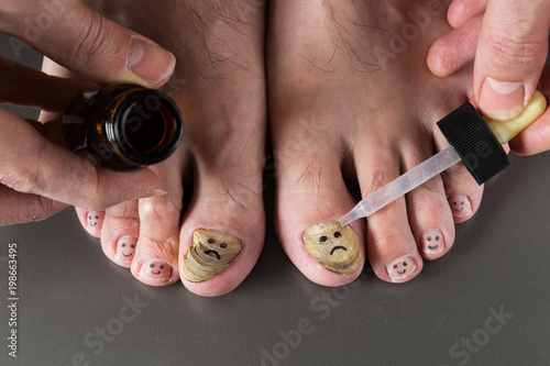 nail fungus care or nail fungus treatment.  