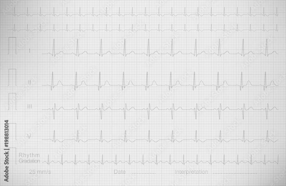 ECG drawing on the square paper, vector image