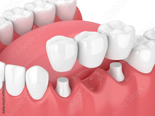 3d render of jaw with dental bridge photo