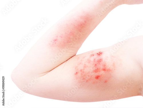 Atopic dermatitis (AD), also known as atopic eczema, is a type of inflammation of the skin (dermatitis) at foot.