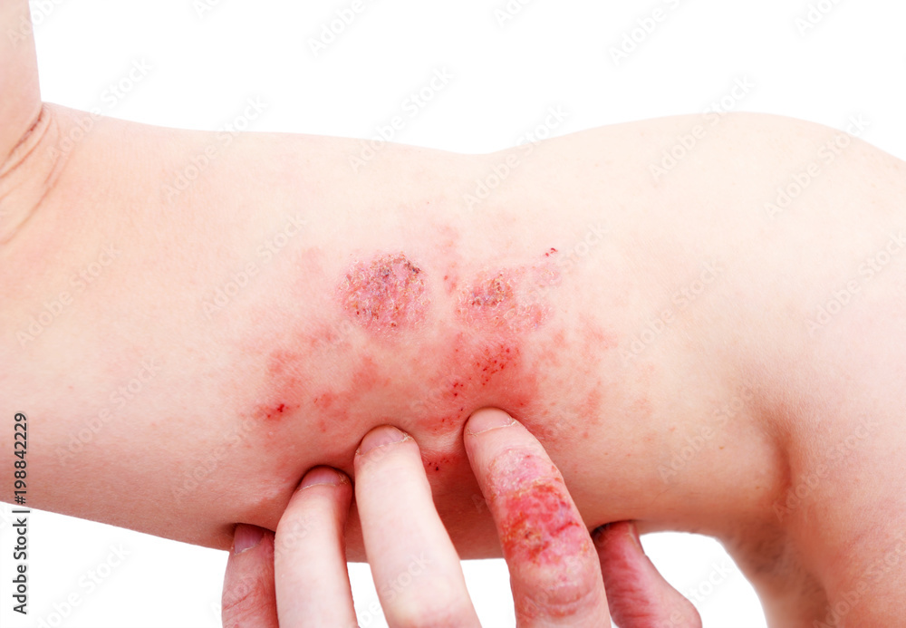 Atopic dermatitis (AD), also known as atopic eczema, is a type of inflammation of the skin (dermatitis) at foot. Atopic dermatitis (AD), also known as atopic eczema, is a type of inflammation of the skin (dermatitis) at foot.