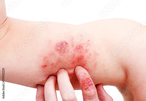 Atopic dermatitis (AD), also known as atopic eczema, is a type of inflammation of the skin (dermatitis) at foot. photo