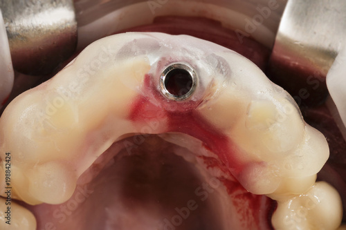 place in the dental template for screwing the implant