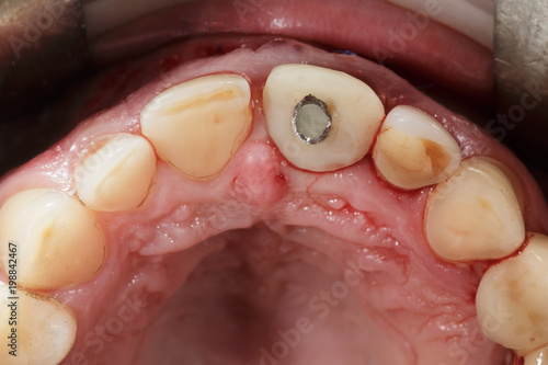 screwed ceramic tooth with abutment processing