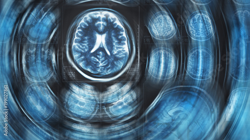 Photography Mri brain scan background, magnetic resonance  tomography, with blur circle moti