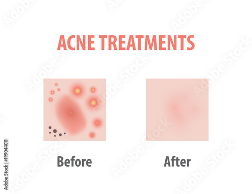 Acne treatments diagram illustration vector on white background, Beauty concept.