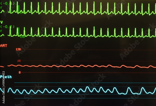 Supraventricular Tachycardia on Monitor in Green, arterial blood pressure in red and oxygen saturation in blue, all against a black background.