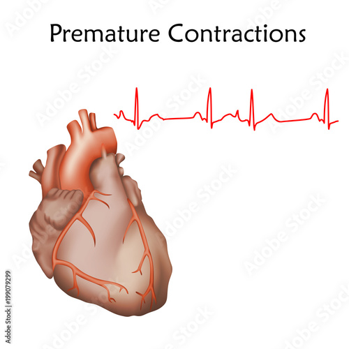 Human heart. Premature Contractions. Anatomy illustration. Red image, white background. Heartbeat, pulse, ecg.