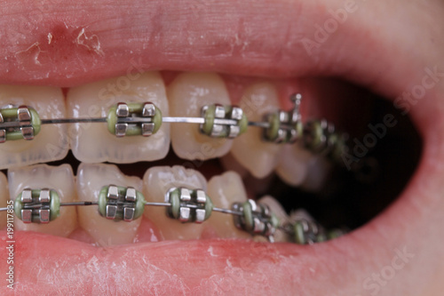 braces in the young mouth