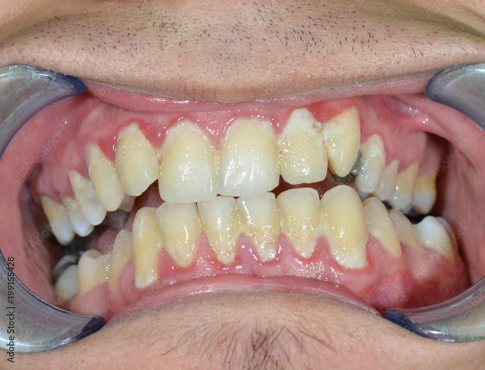 massiver Zahnbelag, gingivitis, zahnfleischentzündung, dentale plaque