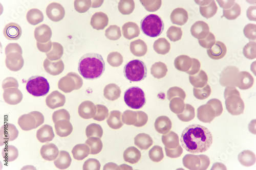 Blood smear of chronic lymphocytic leukemia (CLL), analyze by microscope 