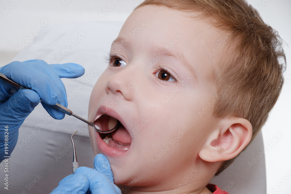 Medical examination of child patient teeth using a mirror by a dentist. Caries, tooth damage. Medical examination of child patient teeth using a mirror by a dentist. Caries, tooth damage.