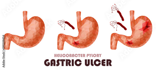 Realistic low poly human stomach and duodenum set. Healthy stomach, ulcer diseases, helicobacter pylori bacteria attack.