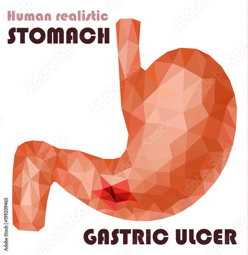 Realistic low poly human stomach and duodenum. Ulcer diseases, helicobacter pylori bacteria attack.