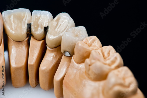 Dental prosthesis model with ceramic teeth isolated on the black background.