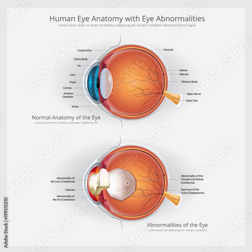 Eye Anatomy with Eye Abnormalities Vector Illustration © pongpongching