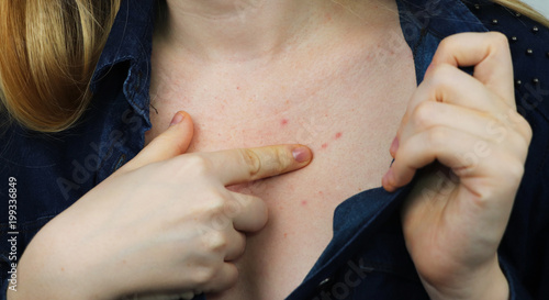 Allergy concept. Young woman with pimples on the chest, closeup photo