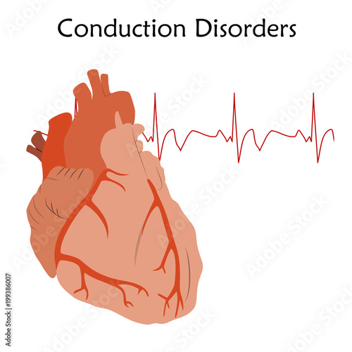 Human heart. Conduction Disorders. Anatomy flat illustration. Red image, white background. Heartbeat, pulse.