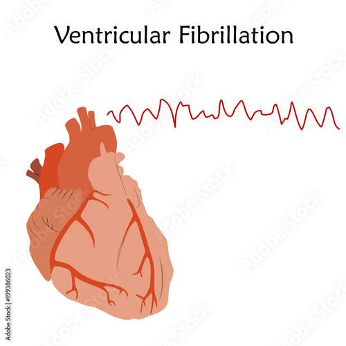 Human heart. Ventricular Fibrillation. Anatomy flat illustration. Red image, white background. Heartbeat, pulse.