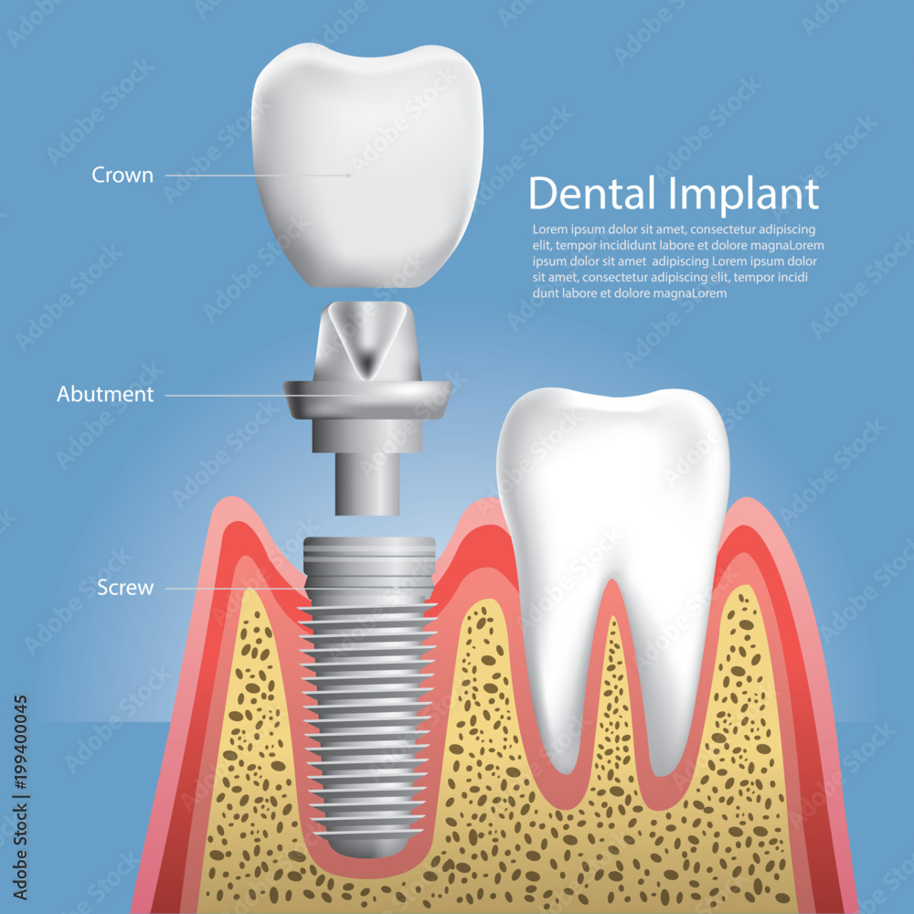 Fototapeta premium Human teeth and Dental implant Vector Illustration