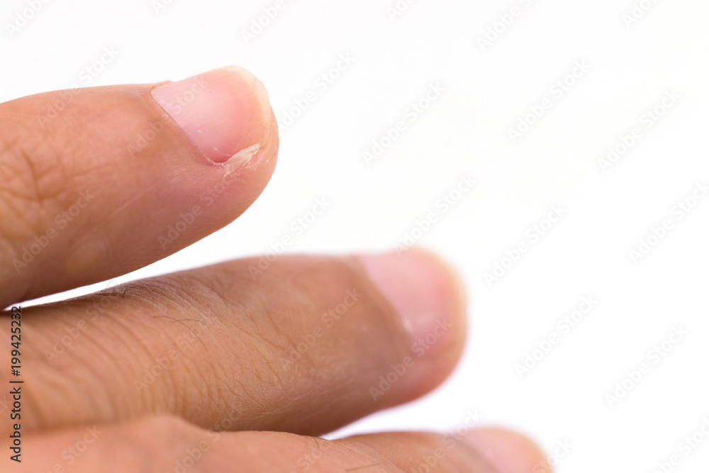 Fingers and nails shows Paronychial of nail on white background