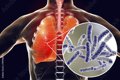 Legionella pneumophila bacteria in human lungs, 3D illustration, the causative agent of Legionnaire's disease photo