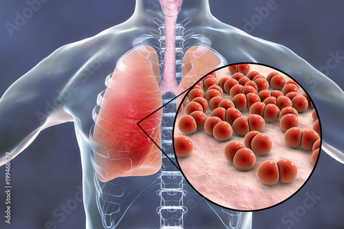 Pneumococcal pneumonia, medical concept. 3D illustration showing bacteria Streptococcus pneumoniae in human lungs photo