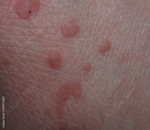 Warts on the skin of human hands. Skin disease. photo