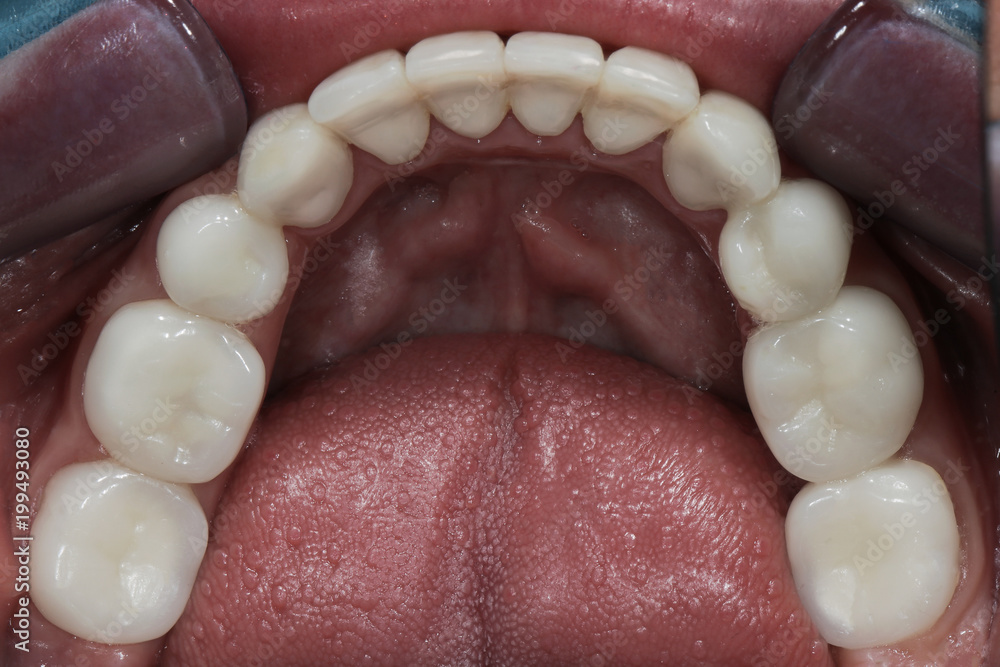 Obraz premium ceramic teeth after fixation