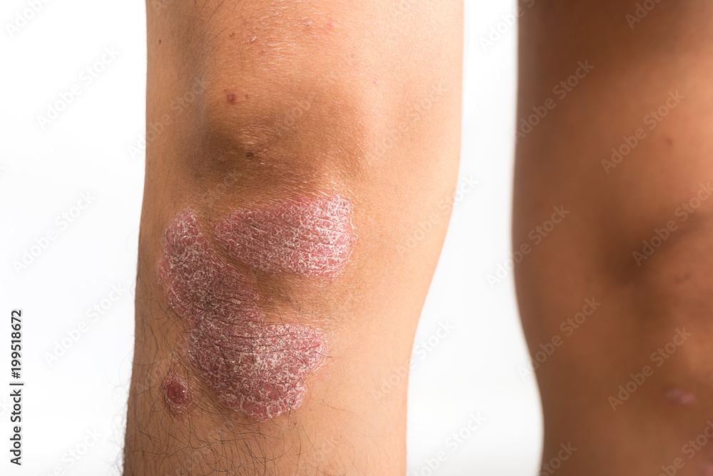 Fototapeta premium Psoriasis that knee on white background