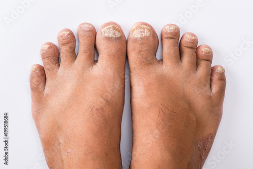 Psoriasis that Pedicure on white background © tumeyes