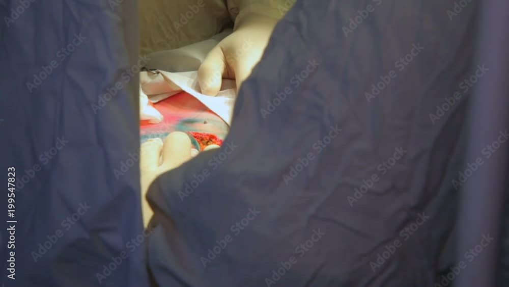 Oncology. Removal of a malignant tumor of the mammary gland. Installation of a breast implant after removal of a cancerous tumor. Oncology. Removal of a malignant tumor of the mammary gland. Installation of a breast implant after removal of a cancerous tumor.