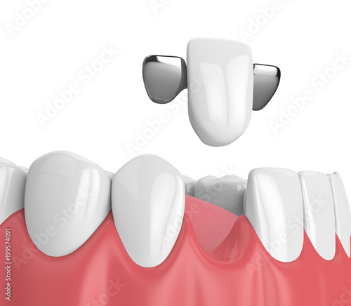 3d render of jaw with teeth and maryland bridge