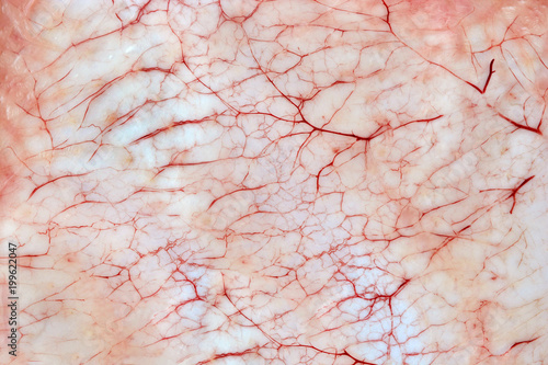 Bloody inflammatory capillaries on the skin