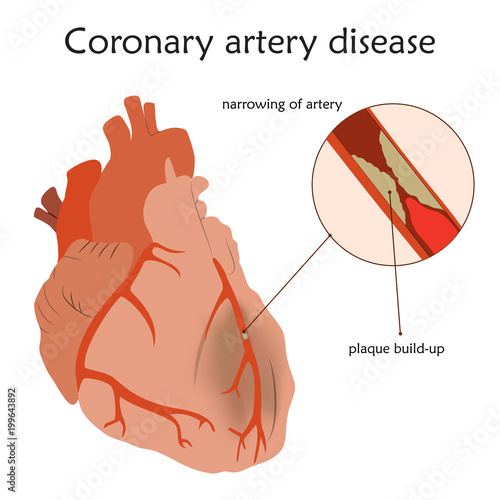 Coronary artery disease. Blocked artery, damaged heart muscle. Anatomy flat illustration. Colorful image, white background.