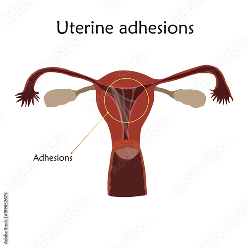 Uterine adhesions. Human realistic uterus. Anatomy flat illustration with specification. Colored image, white background. Gynecological diseases.