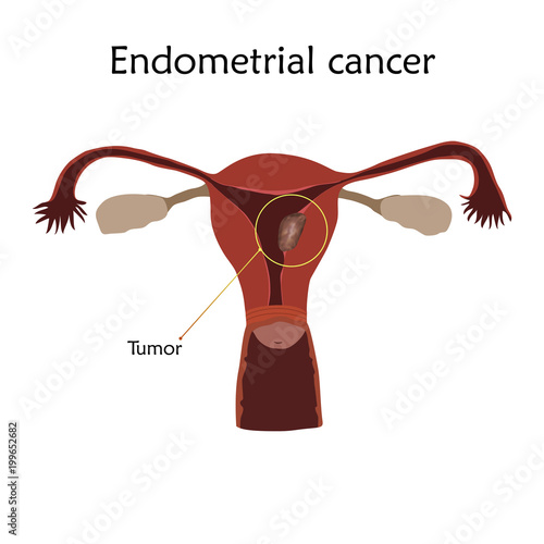 Endometrial cancer. Human realistic uterus. Anatomy flat illustration with specification. Colored image, white background. Gynecological diseases.
