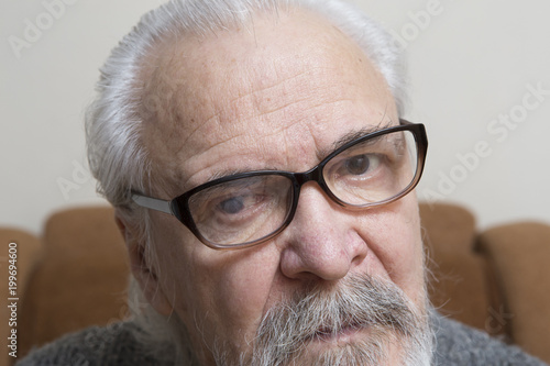 Lonely old man with sore eyes photo