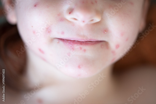 Chickenpox on the body of a little girl photo