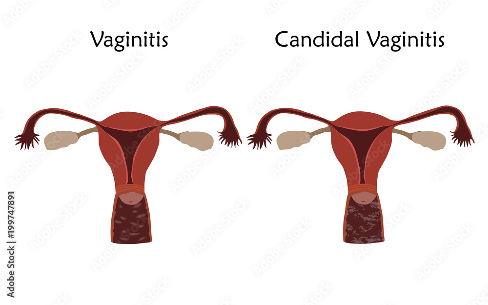 candidal vaginitis