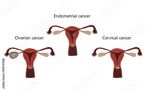 Ovarian, endometrial and cervical cancer. Human realistic uterus. Anatomy flat illustration. Colored image, white background. Gynecological diseases.