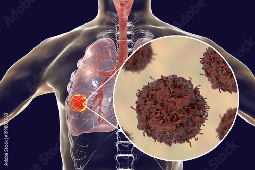 Lung cancer, tumor inside lung and close-up view of pulmonary cancer cells, illustration