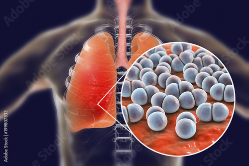 Canvastavla Pneumococcal pneumonia, medical concept
