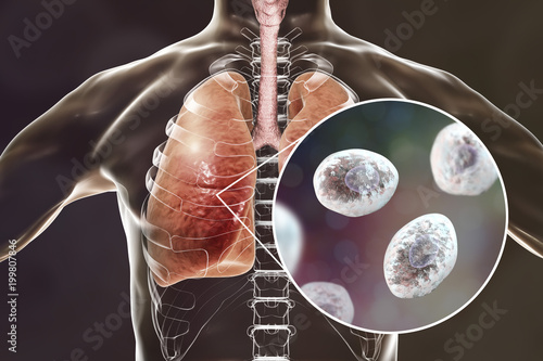 Cuadro en lienzo Pneumocystis jirovecii or carinii in human lungs, opportunistic fungus that caus