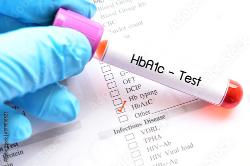 Blood sample for HbA1c test, diabetes diagnosis 