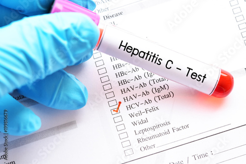 Blood sample for hepatitis C virus (HCV) test